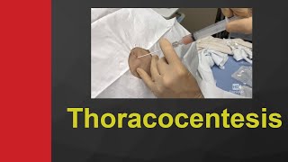 Thoracocentesis Plural tapping step by step procedure [upl. by Geier]