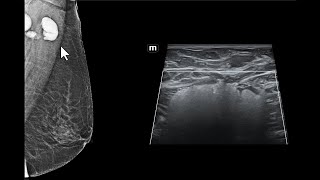 Impregnação de linfonodos axilares por silicone Achados da mamografia e da ultrassonografia [upl. by Rofotsirk]