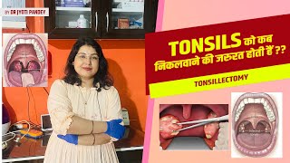 Tonsils को कब निकलवाने की जरुरत होती हैं [upl. by Feirahs]