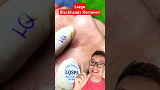 CRAZY BLACKHEAD REMOVAL  Huge Blackheads On Nose shorts [upl. by Blalock]