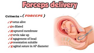 Forceps delivery indications criteria contraindications  medicalmnemonics786 [upl. by Aicella611]