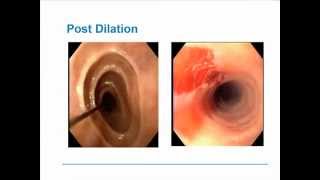 Eosinophilic Esophagitis [upl. by Aneahs]