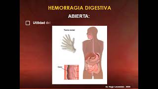 HEMORRAGIA DIGESTIVA PARTE II [upl. by Ibed]