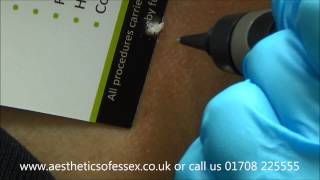 Skin Tags Warts Verrucas amp Millia Removal  Cryo Pen treatment at Aesthetics Of Essex [upl. by Nylakcaj]