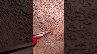 plucking thick beard hairs 🫶🏼 beard plucking satisfyingvideo satisfying tweezing asmrvideo [upl. by Llerat315]