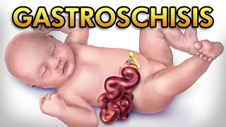 Gastroschisis Pathophysiology Diagnosis Treatment and Comparison against Omphalocele [upl. by Cornela]