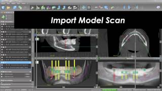 coDIagnostiX for Edentulous Patients Single CBCT and Retention Pins [upl. by Kazmirci]