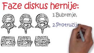 DISKUS HERNIJA [upl. by Evreh785]