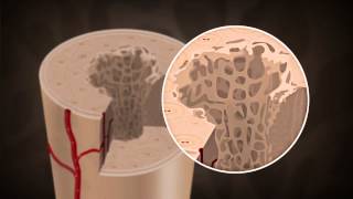 What causes Osteoporosis [upl. by Aisad]