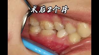 tooth autotransplantation autotransplantation of teeth autogenous tooth transplantation Guangzhou [upl. by Eceirahs667]