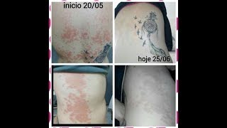 CURED FROM PITYRIASIS ROSEA AND DYSHIDROSIS HANDS WITH AUTOHEMOTHERAPY [upl. by Araes]