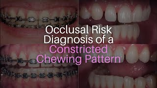 Occlusal Risk Diagnosis of a Constricted Chewing Pattern [upl. by Cathee]