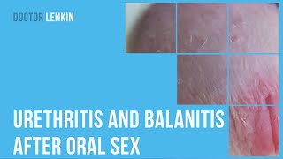 ▶ Urethritis and balanitis after oral sex [upl. by Vale]