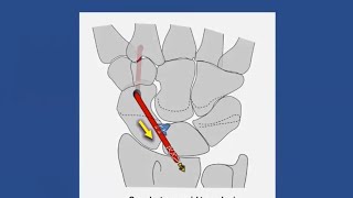 ScaphoLunate Instability EvidenceBased Management [upl. by Epp]