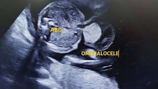 Omphalocele in ultrasound Usg [upl. by Walsh528]