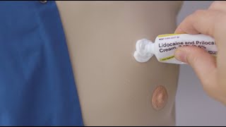 How to apply lidocaine cream to your port [upl. by Eidnim]