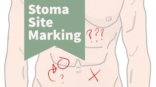 The Importance of Stoma Site Marking [upl. by Ika]