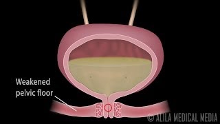 Stress Urinary Incontinence in Women Animation [upl. by Drawe]