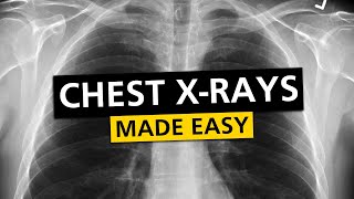 Chest XRay Basics in 5 min [upl. by Yelsnia]