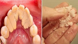 How to Get Rid of Plaque  Home Remedies for Plaque and Tartar [upl. by Assila12]