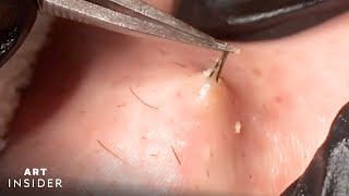 How Ingrown Hairs Are Removed  Art Insider [upl. by Mulford308]