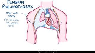 Neumotórax [upl. by Nairbo284]