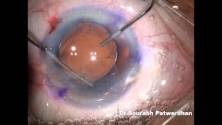 Smart toric IOL customised toric IOL for correcting 10D astigmatism by Dr Sourabh D Patwardhan [upl. by Arval]