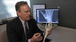 Treating Basal Thumb Joint Arthritis  Mayo Clinic [upl. by Sussi430]