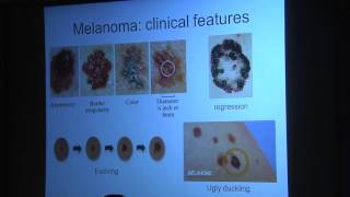 Early Detection of Melanoma [upl. by Bevon564]