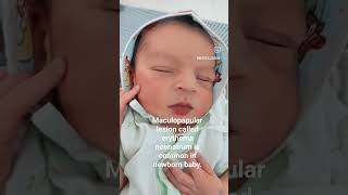 trending  viral shorts  newborn baby shorts  erythema neonatorum in newborn baby [upl. by Dixon]