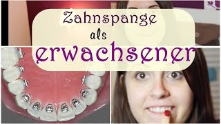 Zahnspange bei erwachsenen  Lingualtechnik  Kosten  JuMarie [upl. by Asila]