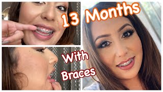 13 Months with BRACES  OverjetOverbite Correction Without Extractions  Damon Braces [upl. by Chico]