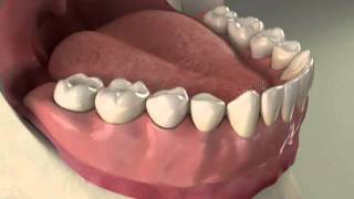 Implants Overdenture Lower Procedure [upl. by Malena]