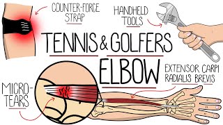 Understanding Tennis Elbow and Golfers Elbow Lateral amp Medial Epicondylitis [upl. by Deth]