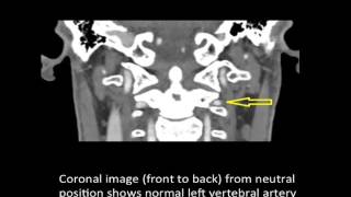 Vertebrobasilar Artery Syndrome  Bowhunters Syndrome  Colorado Spine Surgeon [upl. by Leirea37]