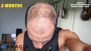 Hair Transplant Growth Timeline  the first 3 months [upl. by Tab633]