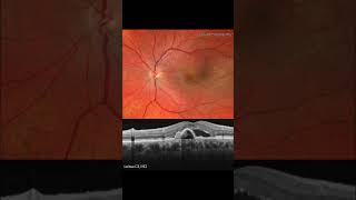 POLYPOIDAL CHOROIDAL VASCULOPATHY MULTIMODAL ANALYSIS For more images like this visit wwwretinograp [upl. by Romy]