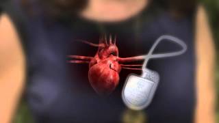 DefibrillatorPacemaker Whats the Difference [upl. by Pryce]