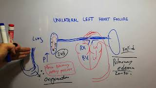 CVS 218  Unilateral left heart failure  Pathophysiology of Acute pulmonary edema [upl. by Mella]