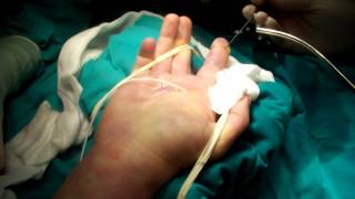 Flexor Tendon Sheath WashoutMOV [upl. by Fritzsche]