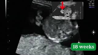 Its a baby girl but there is a propblem  GASTROSCHISIS  Ultrasound Case [upl. by Zusman]