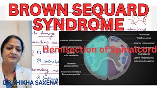 Brown Sequard Syndrome Hemisection of Spinal cord [upl. by Ylhsa]