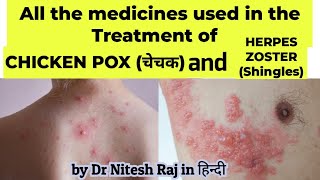 Chicken poxछोटी माताचिकन पॉक्स and Herpes zoster ka ilaz in hindiby Dr Nitesh Raj [upl. by Kung890]