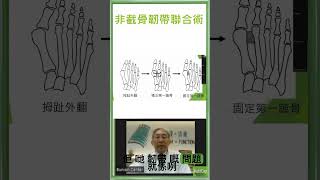 韌帶聯合術有什麼程序What is the syndesmosis procedure [upl. by Latona]