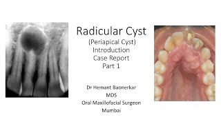 Radicular Cyst  Periapical Cyst  Case Report Series Part 2 [upl. by Zwart936]