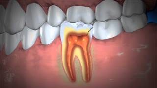 Treatment of Abscessed Teeth [upl. by Garrity960]