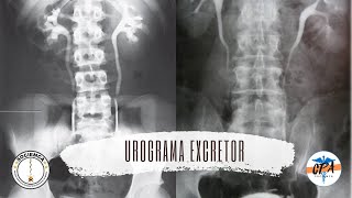 Urograma Excretor [upl. by Tome206]