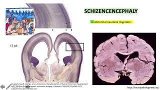 Porencephaly versus Schizencephaly 22 [upl. by Inimak]