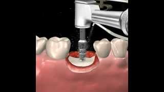 Step by step dental implant surgery Gary R OBrien DDS [upl. by Gerg]