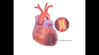 Physical Examination for Patients with Coronary Artery Disease [upl. by Ehtylb]